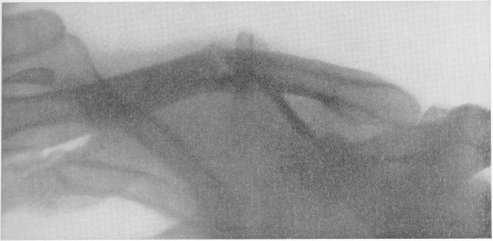 Рис. 62. Поперечный перелом левой ключицы в средней трети с небольшим угловым смещением, требующим исправления.