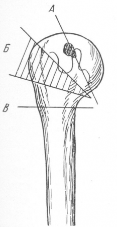 Рис. 63. Схематипичных переломов в верхней трети плечевой кости. Переломы анатомической шейки (А), чрезбугорковый (Б) и хирургической шейки (В).