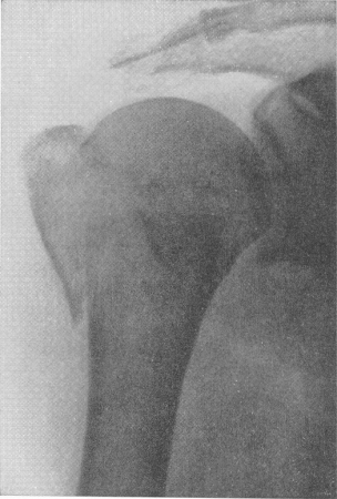 Рис. 64. Вклиненный перелом хирургической шейки плеча с отломом и боковым смещением большого бугорка.
