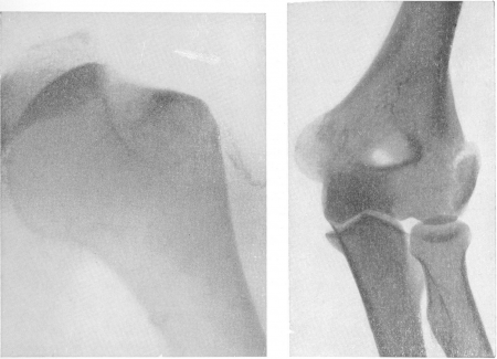 Рис. 66. Привычный вывих, то же наблюдение. Рентгенография при вращении плеча внутри. Выявляется типичная картина краевого дефекта головки плеча. Рис. 67. Внутрисуставной перелом наружного мыщелка плеча у взрослого.