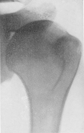 Рис. 65. Привычный вывих левого плеча у 28-летнего борца. Обычная рентгенограмма после вправления восьмого по счету вывиха не обнаруживает каких-нибудь патологических изменений.