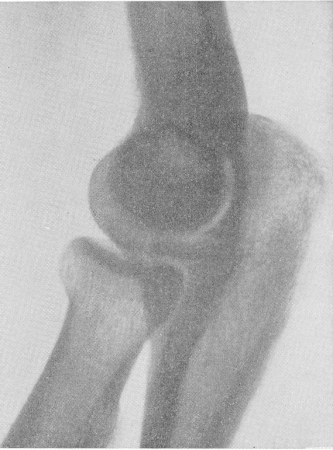 Рис. 68. Внутрисуставной перелом венечного отростка локтевой кости с незначительным смещением отломка.