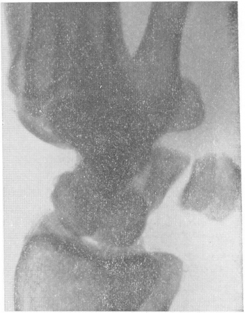 Рис. 72. Изолированный перелом гороховидной кости, невидимый на обычной прямой рентгенограмме в ладонном положении кисти.