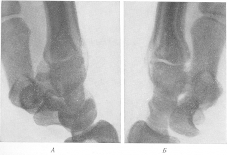 Рис. 76. Тоже наблюдение. Рентгенограммы запястья в боковом положении. А —нормальная левая сторона для сравнения; Б—вывих полулунной кости в ладонном направлении. Клинически — картина тяжелого травматического повреждения.