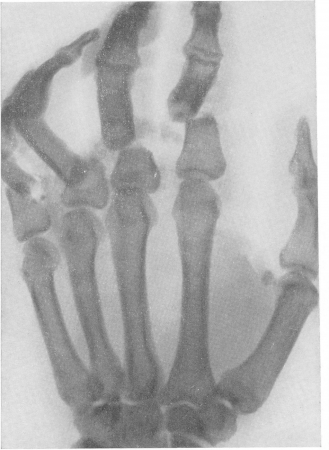 Рис. 78. Типичный перелом четырех ульнарных основных фаланг руки, вызванный травмой от автомобильной дверцы.