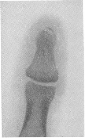 Рис. 79. Типичная картина краевого отлома ногтевого отростка ногтевой фаланги от удара молотком по пальцу.