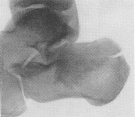 Рис. 86. Перелом пяточной кости при падении с трамвая. Видна линия перелома, а также деформация кости при нарушении структурного рисунка.
