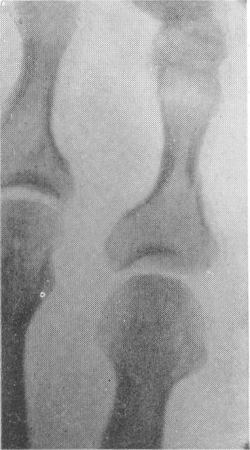 Рис. 89. Косой внутрисуставной перелом основания основной фаланги V пальца стопы, возникший вследствие прямого удара краем упавшей табуретки.