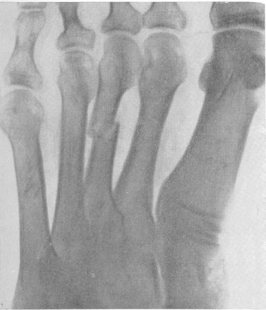 Рис. 88. Свежий поперечный перелом средней трети диафиза III плюсневой кости с небольшим боковым смещением дистального отломка. Перелом вызван падением лома на тыл стопы.