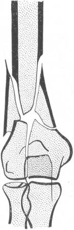 Рис. 90. Схематическое изображение огнестрельного перелома кости в виде так называемых „крыльев бабочки”. Продольная щель в локтевой сустав.