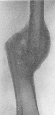 Рис. 101. Крупная прочная боковая костная мозоль после заживления огнестрельного перелома средней трети диафиза бедренной кости. Некоторое укорочение кости, неисправленное угловое смещение сросшихся отломков.
