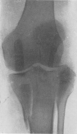 Рис. 105. Свежее огнестрельное повреждение коленного сустава. Продольная внутрисуставная щель медиального эпифиза большеберцовой кости.