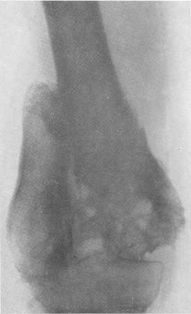 Костный анкилоз коленного сустава после огнестрельного гонита и остеомиелита нижней трети бедра, осложнившего продольный внутрисуставной перелом бедренной кости.