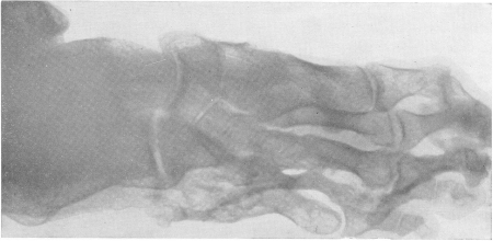 Рис. 122. Глубокие нейротрофческие изменения стопы у раненного 6 лет назад стойкое поражение крупных нервных стволов голени.