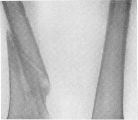 Рис. 123. Патологический диафизарный перелом правой бедренной кости при значительном общем остеопорозе у раненного 6 лет назад в нижнегрудной отдел позвоночника с поражением спинного мозга.