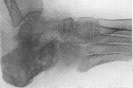 Рис. 135. Туберкулез пяточной кости при типичной клинической картине. Заметный остеопороз стопы.