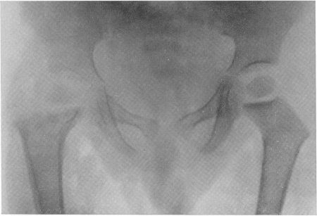 Рис. 136. Изолированный туберкулезный очаг в шейке правого бедра с секвестрацией и надкостничной реакцией двухмесячной давности у двухлетнего ребенка.