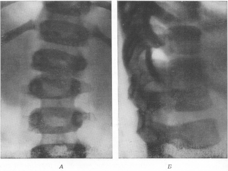 Рис. 138. Туберкулезный спондилит у мальчика 21/2 лет; около месяца боли в животе. А — прямая рентгенограмма; Б — боковая рентгенограмма.
