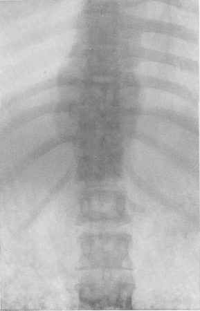Рис. 141. Туберкулезный спондилит VIII—XII грудных позвонков с грушевидным натечным абсцессом.