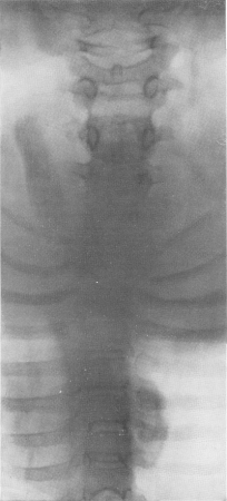 Старые обызвествленные натечные абсцессы в грудном отделе (справа от позвоночника) и в поясничном отделе (слева у края поясничной мышцы) при затихшем туберкулезном спондилите.