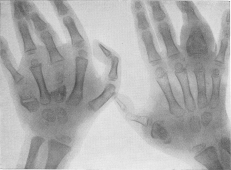 Рис. 144. Spina ventosa tuberculosa — множественные поражения фаланг и пястных костей у ребенка с генерализованным гематогенным туберкулезом.