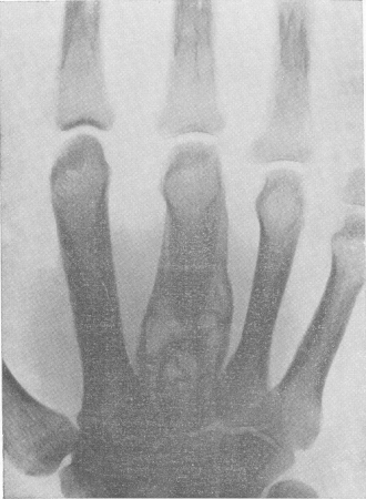 Рис. 145. Spina ventosa tuberculosa III пястной кости у 52-летней женщины, создавшая значительные дифференциально-диагностические трудности. Гистологическое подтверждение диагноза.