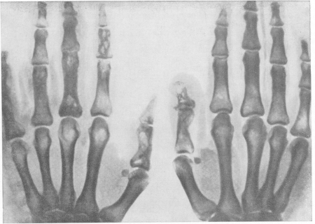 Рис. 146. Множественный кистовидный или кавернозный туберкулезный остит Юнглинга. Двусторонний асимметричный костный процесс у 30-летней женщины с типичными кожными поражениями на пальцах обеих рук. Остеопороз отсутствует. Гистологическое подтверждение.