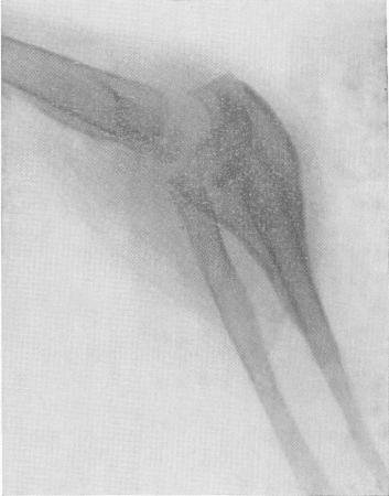 Рис. 148. Туберкулезное поражение локтевой кости типа spina ventosa с переходом на локтевой сустав у двухлетней девочки. Закрытая форма. Гистологическое и бактериологическое подтверждение диагноза.