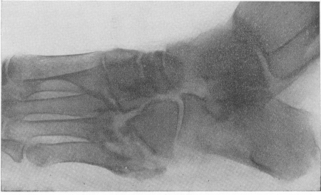 Рис. 151. Туоеркулезный артрит наружного отдела лисфранкова сустава у 30-летнего больного. Свищевая форма.