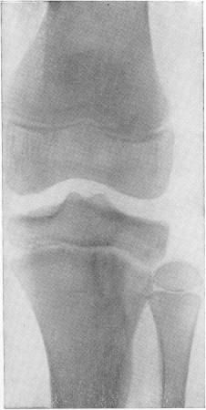Рис.152. Первично-костная форма туберкулезного гонита. Типичный эпи-метафизарный костный очаг в латеральной части большеберцовой кости до непосредственного перехода в суставную полость. Клинически на первом плане симптомы экссудативного синовита.