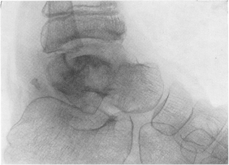 Рис. 154. Первично-костная форма туберкулезного артрита голеностопного сустава годичной давности у 10-летнего мальчика. Некротический подхрящевой участок — секвестр — суставной поверхности таранной кости, вдавленный в частично разрушенную кость.