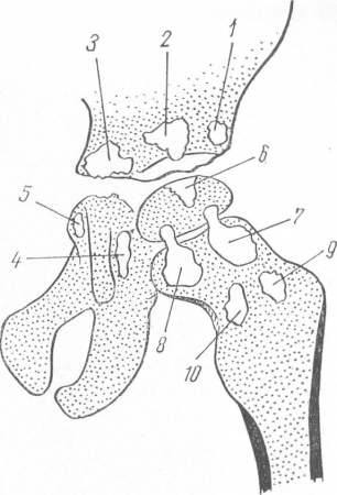 Рис. 157. Схема расположения очагов при туберкулезе тазобедренного сустава. 1 — вертлужный наружный (латеральный), 2 — вертлужный центральный, 3 — вертлужный внутренний (медиальный), 4 — седалищный, 5 — лобковый, 6 — эпифизарный, 7 —шеечный верхненаружный, 8 — шеечный верхневнутренний, 9 — шеечный нижненаружный, 10 — шеечный нижневнутренний (по Г. А. Зедгенидзе, В. П. Грацианскому и Ф. Ф. Сивенко).