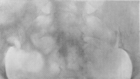 Рис. 164. Туберкулез правого пояснично-крестцового сочленения (туберкулезный сакроилеит).