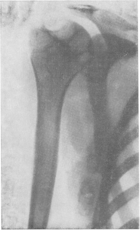 Рис. 167. Типичная картина туберкулезной сухой костоеды плечевой головки (cades sicca tuberculosa). Обызвествленные туберкулезные лимфатические узлы в подмышечной области.