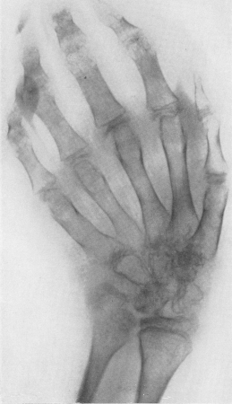 Рис. 169. Рентгенограмма кисти и лучезапястного сустава 10-летнего мальчика с типичной клинико-рентгенологической картиной болезни Стилла.