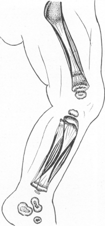 Множественные диафизарные слоистые периоститы длинных трубчатых костей и остеохондрит при врожденном сифилисе у грудного ребенка (схематическое изображение).