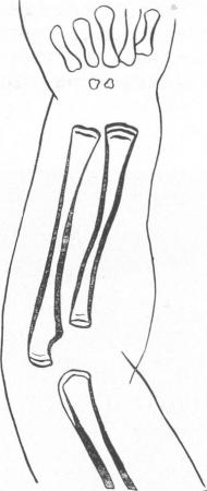 Рис. 177. Схематический рисунок. Врожденный костный сифилис. Зоны затемнения и просветления в метафизарных концах длинных трубчатых костей в результате внутриутробного специфического лечения.