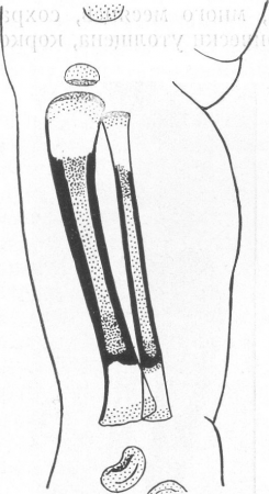 Схематическое изображение метафизарных поясов остеопороза при врожденном внутриутробно леченном сифилисе.