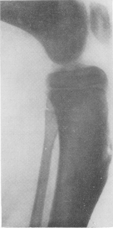 Рис. 181. Изолированная солитарная поднадкостничная гумма большеберцовой кости при третичном сифилисе у 12-летнего мальчика с типичным поздним врожденным сифилисом.