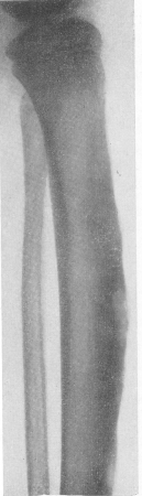 Множественные изолированные поднадкостничные гуммы при позднем врожденном сифилисе. Небольшое удлинение пораженной большеберцовой кости и искривление ее в виде сабельных ножен.