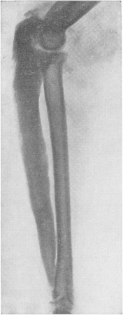 Рис. 186. Диффузно-гипер-остотическая форма третичного сифилиса локтевой кости с переходом на локтевой сустав. Почти полный эностоз — лишь в дистальной трети диафиза сохранился костномозговой канал.