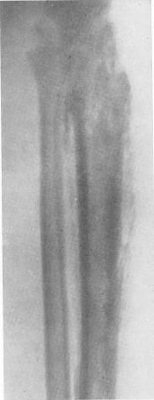 Рис. 196. Тотальный диафизарный секвестр большеберцовой кости при хроническом гематогенном остеомиелите.