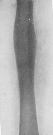 Рис. 209. Типичная картина склерозирующего остеомиелита Гарре. Поражена середина диафиза бедренной кости. Оперативное, гистологическое и бактериологическое подтверждение диагноза (высеян золотистый стафилококк).