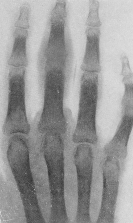 Рис. 218. Гнойный артрит проксимального межфалангового сустава III пальца. Значительный остеопороз.