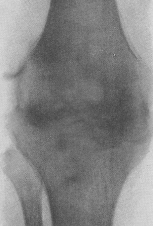 Рис. 229. Гонорейный артрит коленного сустава у 24-летнего мужчины, развившийся через 10 месяцев после острого осложненного гонококкового уретрита. Чрезвычайно резкие боли в последнее время несколько стихли в связи с образованием костного анкилоза. Остеопороз.