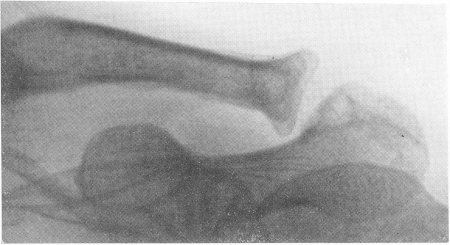 Рис. 238. Бруцеллезный остеоартроз левого акромио-ключичного сустава у мужчины с типичным общим бруцеллезом. Положительная реакция Бюрне.