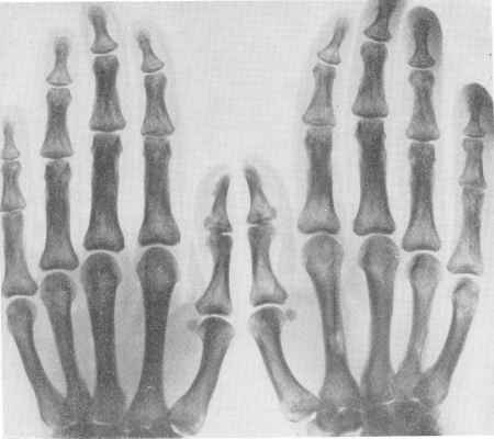 Рис. 241. Ревматические гранулемы костей и периоститы у 28-летней женщины с типичной клинической картиной ревматизма. Гистологическое подтверждение диагноза при биопсии одного из патологических очагов. Особенно отчетливо видны гранулематозные деструктивные очаги в основных фалангах V пальца слева и указательного пальца справа, а также в диафизах II и IV пястных костей на правой конечности, где лучше выражены и надкостничные разрастания.