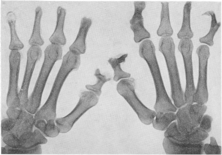 Рис. 246. Проказа. Нервная форма трехлетней давности у 22-летнего больного. Отшнуровка мягких тканей, пальцы рук имеют вид обрубков. Двустороннее асимметричное обезображивание (мутиляция) скелета пальцев. Остеопороз. Множественный остеолиз.