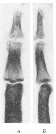 Рис. 244. Чинга. Типичное поражение дистального межфалангового сустава у охотника, поранившего руку во время свежевания нерпы на промысле в Северном море. А — прямая рентгенограмма; Б — боковая рентгенограмма.