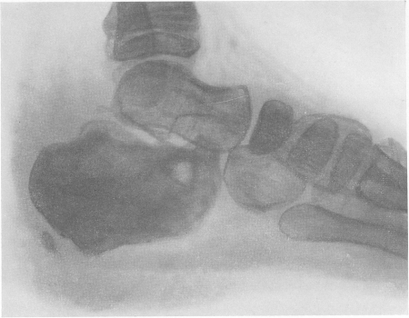 Рис. 251. Актиномикоз пяточной кости у 7-летнего мальчика с распространенным хроническим септическим актиномикозом — поражением легких, плевры, грудной стенки, ряда костей. Микроскопическое и секционное подтверждение диагноза.